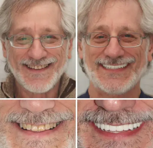 ROSOPL™ Custom-Fit Functional Denture - Image 3